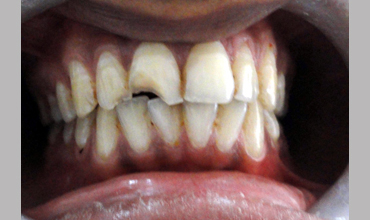 Veneerscrown and bridges treatment in Anand
                        